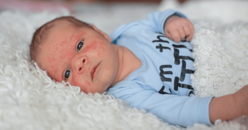 Acne neonatal: o que é e como tratar?