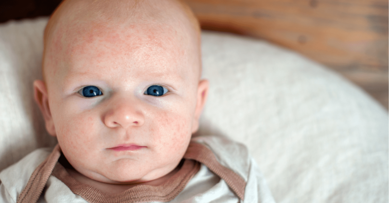 Dermatite Atópica (eczema) no bebé: sinais e sintomas